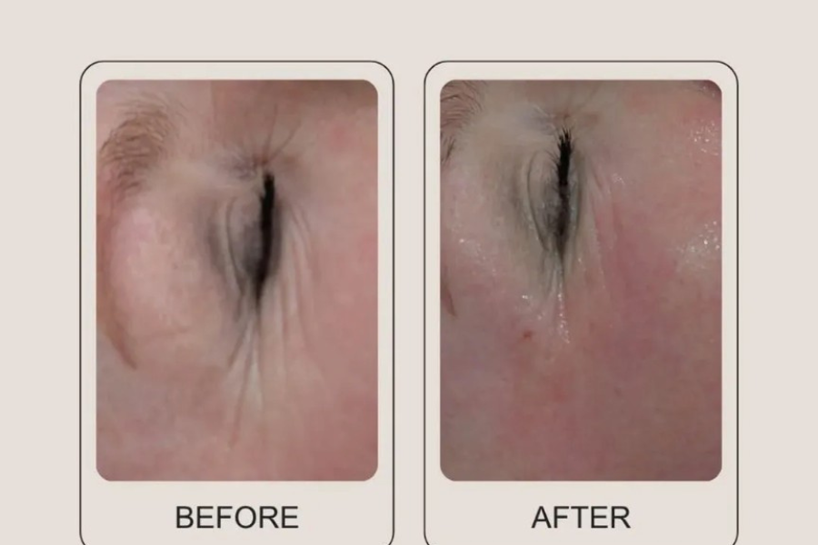 Before and After Derma 2.0 Lifting
